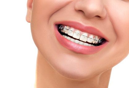 Adult Clear Braces 35