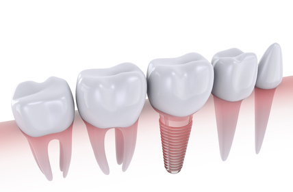 dental implant cornwall